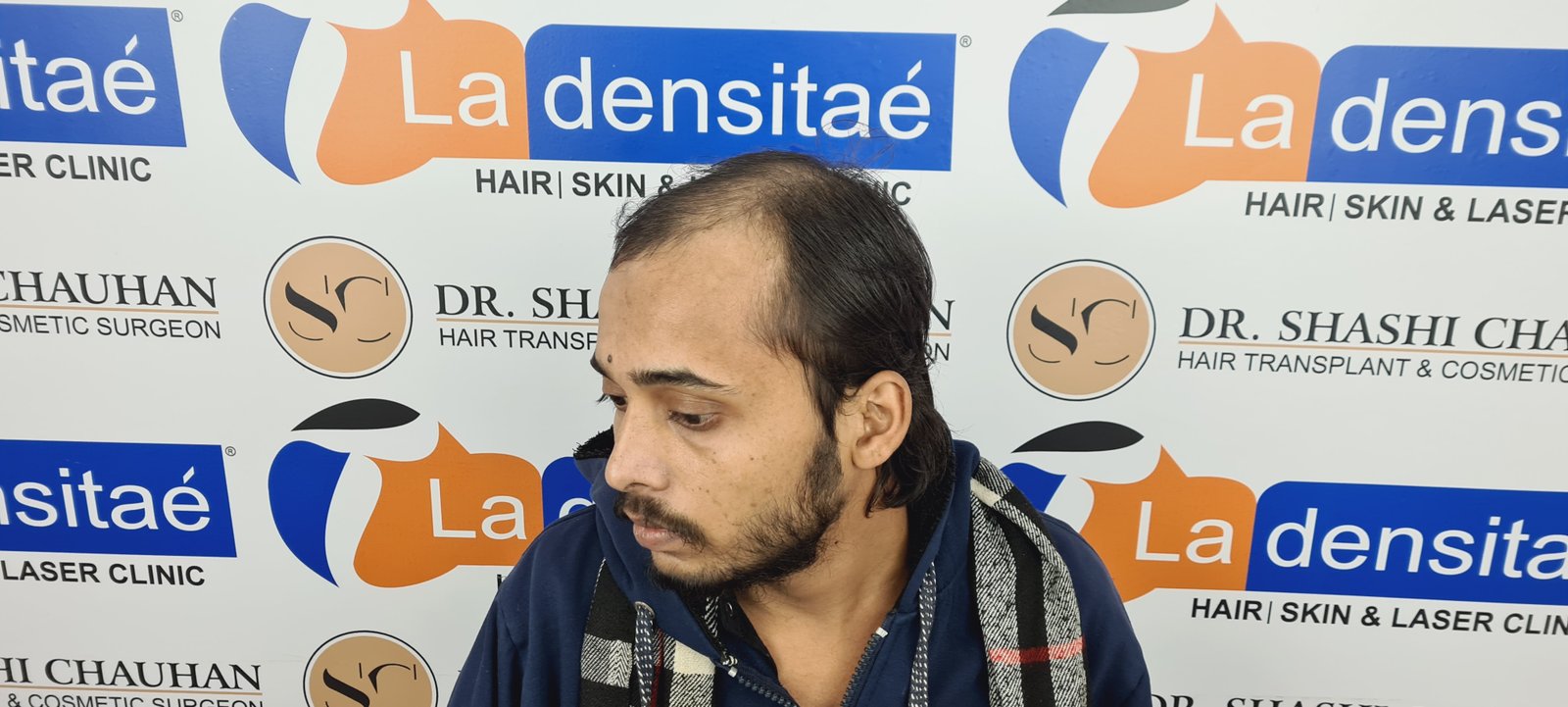 Ashis Yadav Before Hair Transplant